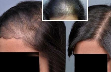 استخدمي هذه الحيل على شعرك وتخلصي من الصلع في أسبوع فقط