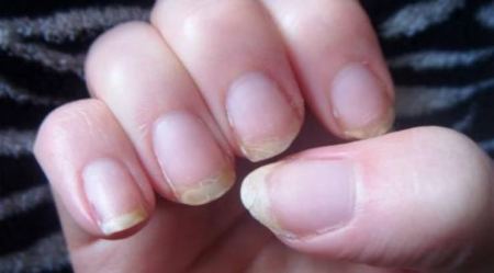 5 طرق بسيطة للتخلص من هشاشة الأظافر