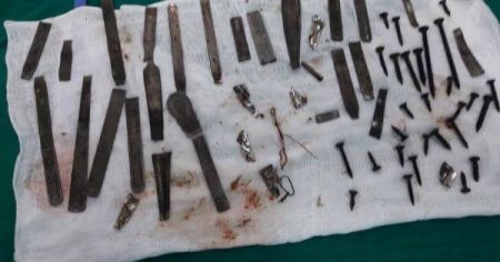 حدث في غزة.. استخراج "ورشة حدادة" من معدة مريض