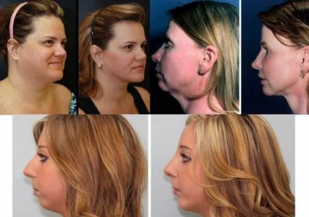 حيلتان تخلّصك من سمنة الذقن... والأولى أسهل مما تتوقع