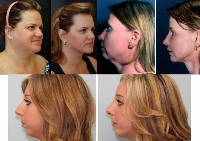 حيلتان تخلّصك من سمنة الذقن... والأولى أسهل مما تتوقع