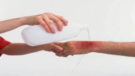 عشبة موجودة بكلّ منزل تخلّصكم من آثار الحروق بـ10 دقائق