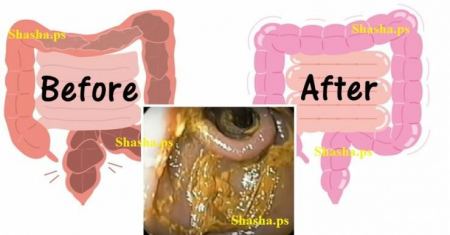 نظف القولون بهذه الـ 8 علاجات وفي أسرع وقت ممكن!