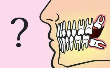  إقرأ قبل أن تُقرر خلع 'ضرس العقل