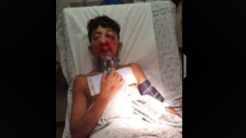 فتية القدس يفقدون اعينهم برصاصة اسرائيلية