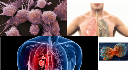 باحثون ...9 من كل 10 حالات سرطان سببها نمط حياة سيء