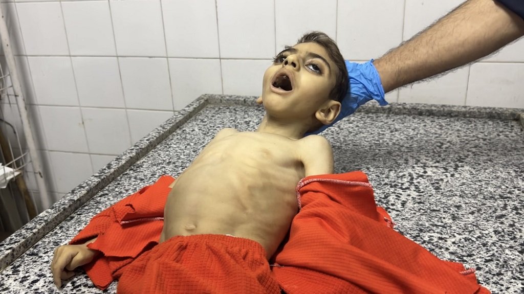 ارتفاع وفيات التجويع إلى 251 بينهم 108 أطفال