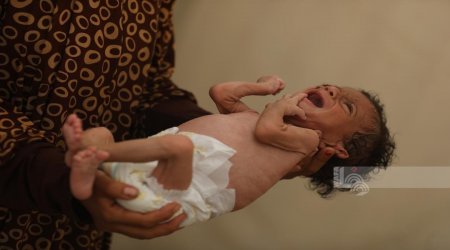 3 وفيات نتيجة المجاعة وسوء التغذية خلال الـ24 ساعة الماضية