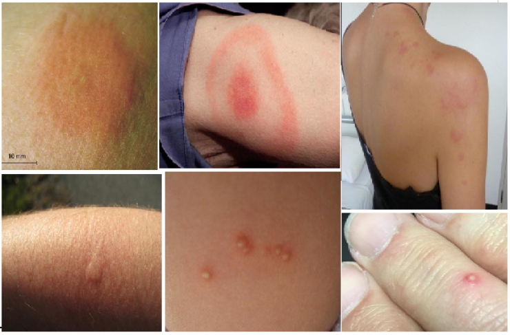 كيف تعالجون فوراً لسعات الحشرات على اختلافها!