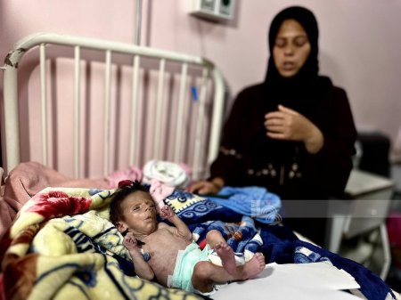 5 وفيات بينهم طفلان نتيجة المجاعة وسوء التغذية في قطاع غزة