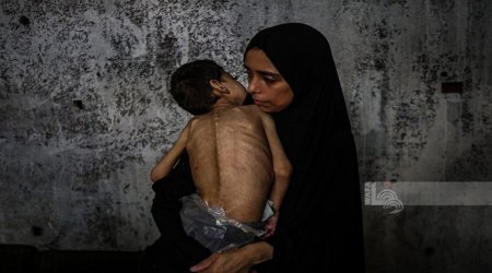 3 وفيات نتيجة المجاعة وسوء التغذية خلال الـ24 ساعة الماضية