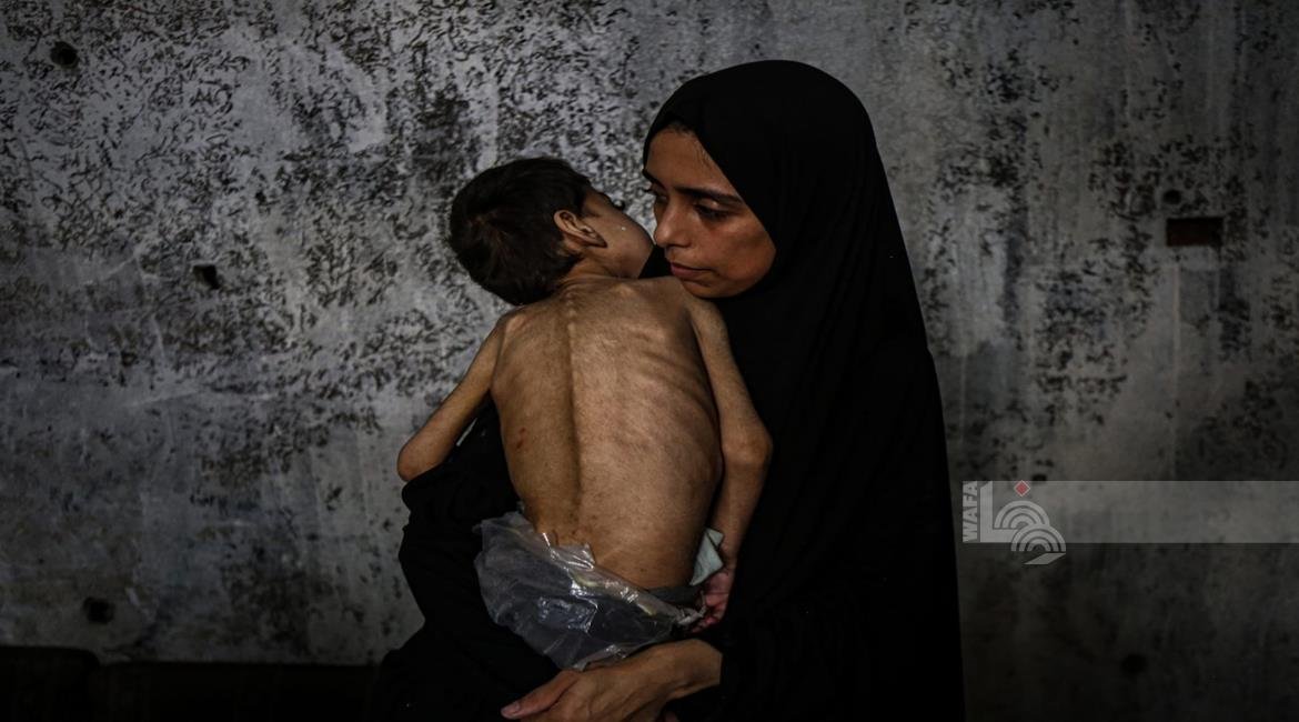 3 وفيات نتيجة المجاعة وسوء التغذية خلال الـ24 ساعة الماضية