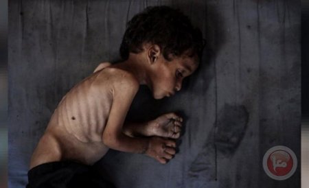 ٣ وفيات نتيجة المجاعة وسوء التغذية خلال الـ 24 ساعة الماضية