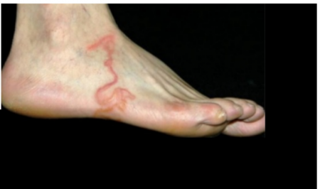 اعتقد أن هذه عروق دوالي.. لكن عندما فحصه الأطباء اكتشفوا المفاجأة!