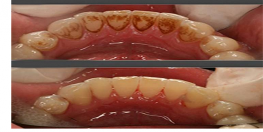 تخلص من جير الاسنان ورائحة الفم بمكون طبيعي واحد وخلال دقائق!