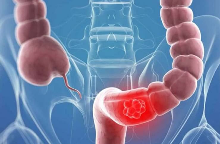 لمرضى القولون العصبي.. لا تقتربوا من هذه الأطعمة