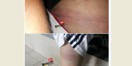 جنين: معلم يعتدي على طالب بالضرب ويتسبب له بكدمات بالغة على جسدة