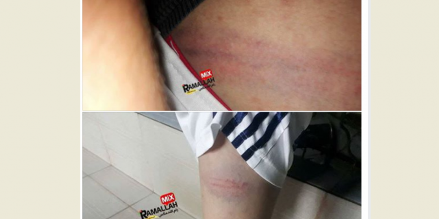 جنين: معلم يعتدي على طالب بالضرب ويتسبب له بكدمات بالغة على جسدة