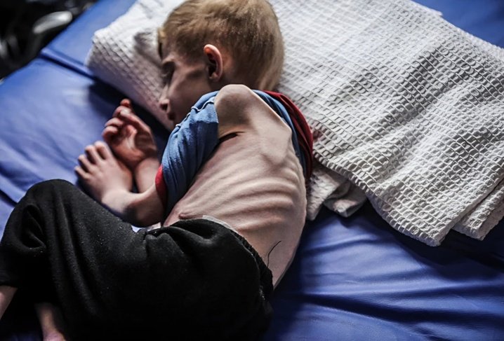 9 حالات وفاة نتيجة المجاعة وسوء التغذية خلال 24 ساعة