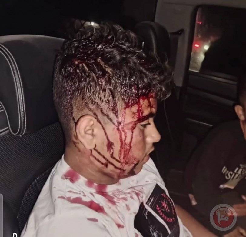 مجزرة استيطانية جديدة في مسافر يطا: اعتداء دموي يطال الأطفال والشيوخ