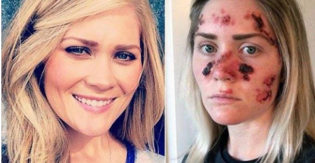 تحذير :ّشيء تستخدمه البنات بكثرة شوّه وجه هذه الحسناء وتركها بهذا الشكل.. ما هو؟