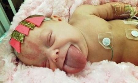 ولدت بلسانِ شخصٍ بالغٍ خرج من فمها.. اليكم قصّة هذه الطّفلة