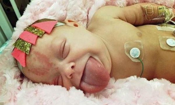 ولدت بلسانِ شخصٍ بالغٍ خرج من فمها.. اليكم قصّة هذه الطّفلة