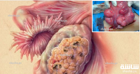 تحذير.. شيء تستخدمه جميع النساء يسبب سرطان المبيض