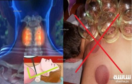 أفضل طريقة لعلاج تشنج الرقبة.. في 60 ثانية فقط!