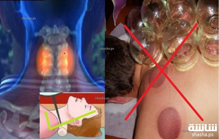 أفضل طريقة لعلاج تشنج الرقبة.. في 60 ثانية فقط!