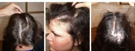 وصفة فعالة لعلاج الصلع المبكر و خاصة عند النساء.. لا تفوتها