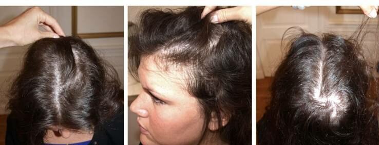 وصفة فعالة لعلاج الصلع المبكر و خاصة عند النساء.. لا تفوتها