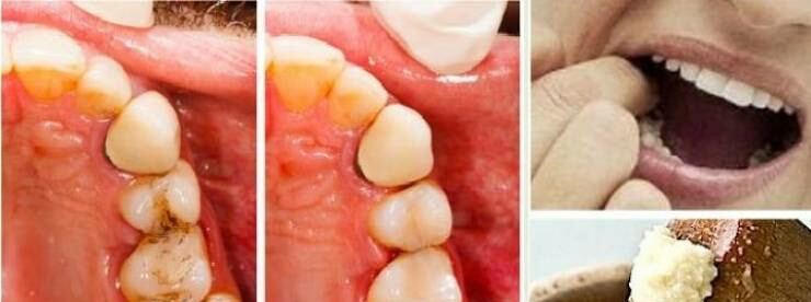 حيل ذكية للتخلص من آلام الأسنان فوراً