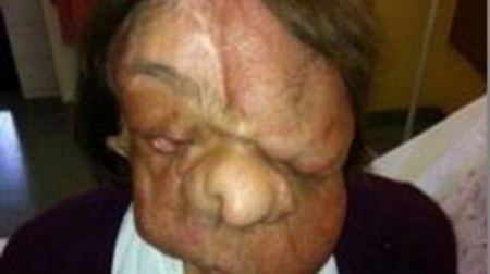 بعد أن خضعت لعمليّة زرع وجه…شاهدوا كيف أصبح شكلها الآن