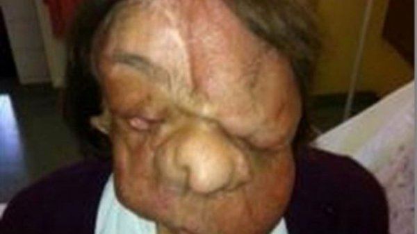 بعد أن خضعت لعمليّة زرع وجه…شاهدوا كيف أصبح شكلها الآن