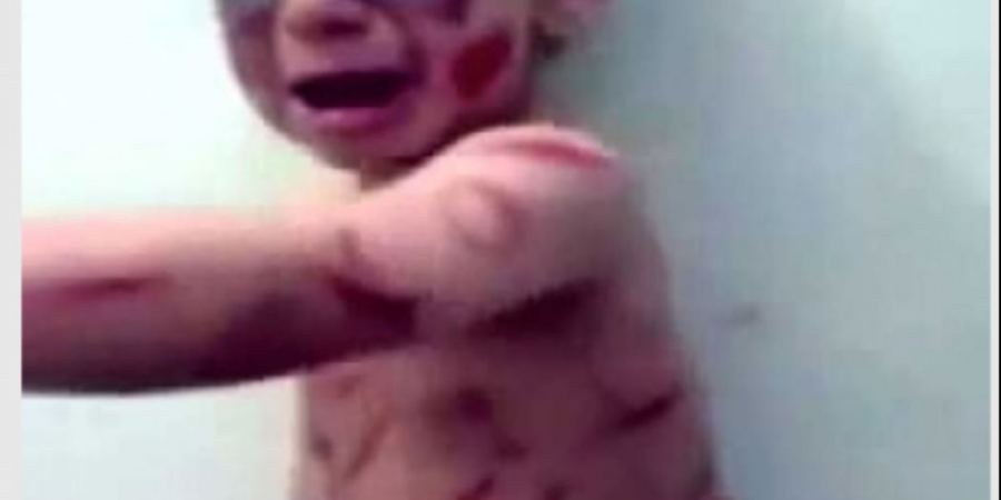 أم ‘تكسر’ ذراعي ابنها و’تحرق’ جسمه لسبب ‘صادم’!