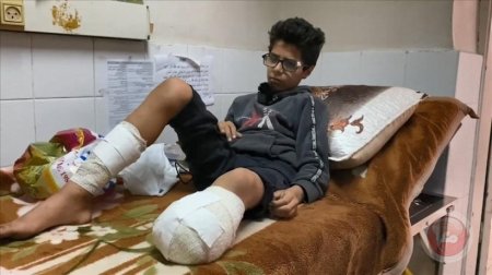 صحة غزة: 6 آلاف حالة بتر بحاجة إلى برامج تأهيل طويلة