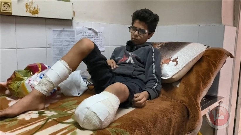 صحة غزة: 6 آلاف حالة بتر بحاجة إلى برامج تأهيل طويلة