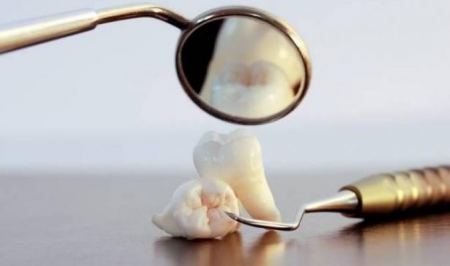 لماذا نسميه "ضرس العقل".. وهل يجب خلعه؟